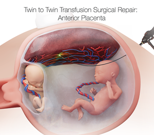 anterior view of twin to twin transfusion syndrome