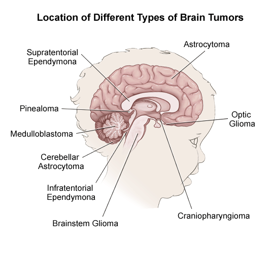 Different Types of Brain Tumors