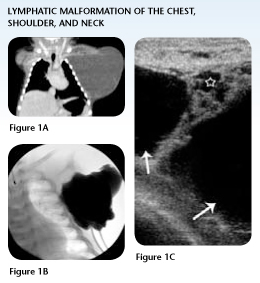 Case Study 1: Lymphatic Malformation of the Neck, Shoulder and Chest