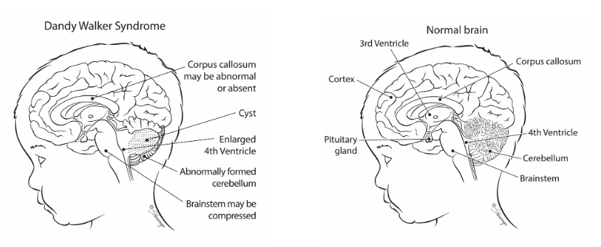 Dandy-Walker Syndrome
