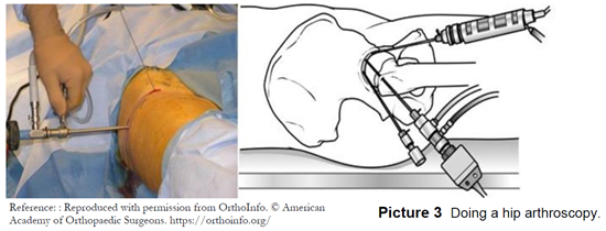 Doing a hip arthroscopy