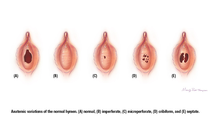 Hymen Variations Group