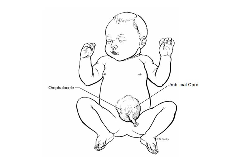 Illustration of an omphalocele