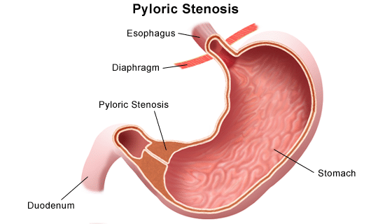 pyloric stenosis