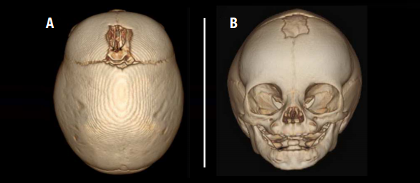 sagittal craniosynostosis