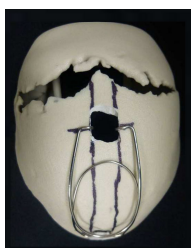 cranial expander springs