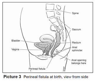 Perineal fistula at birth, view from side