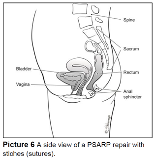 A side view of a PSARP repair with stiches (sutures).