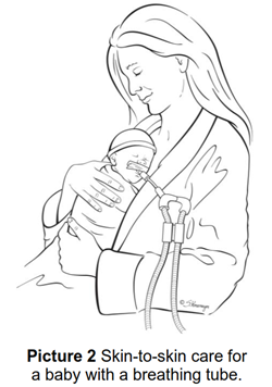 Giving skin-to-skin care to a baby with a breathing tube.