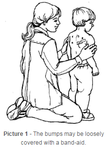 The bumps may be loosely covered with a band-aid