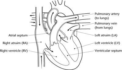 A normal heart after the ductus arteriosus blood vessel has closed