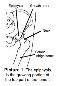 The epiphysis is the growing portion of the top part of the femur