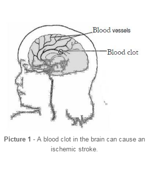 A blood clot in the brain can cause an ischemic stroke