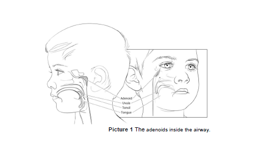 Image of the adenoids inside the airway.