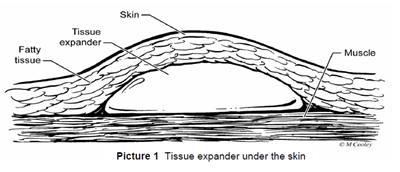 Tissue Expander Under the Skin
