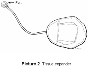 Tissue Expander