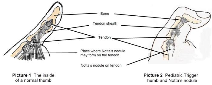 differences between a normal thumb and a pediatric trigger thumb