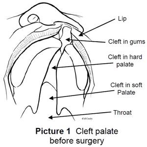cleft palate prior to surgery