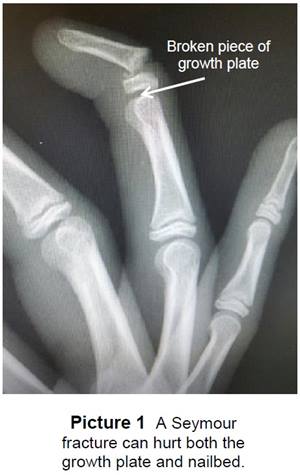 x ray of seymour fracture