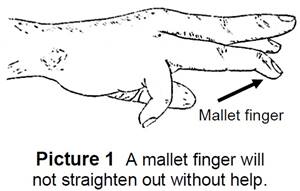 Picture of mallet finger that is bent