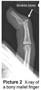 X-ray of a bony mallet finger