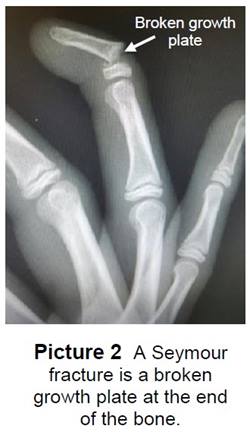 X-ray of a Seymour fracture