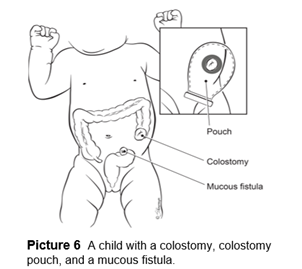 A child with a colostomy, colostomy pouch, and a mucous fistula.