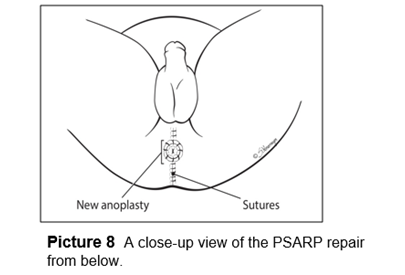 A close-up view of the PSARP repair from below.