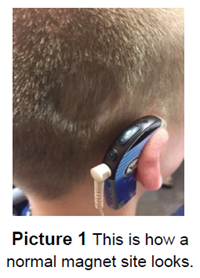 cochlear implant