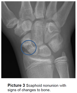 Scaphoid nonunion with signs of changes to bone.
