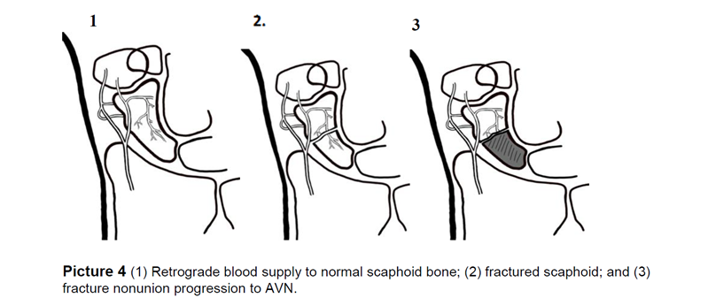 Retrograde blood supply to normal scaphoid bone; (2) fractured scaphoid; and (3) fracture nonunion progression to AVN.