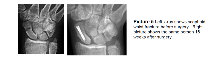 Left x-ray shows scaphoid waist fracture before surgery. Right picture shows the same person 16 weeks after surgery.