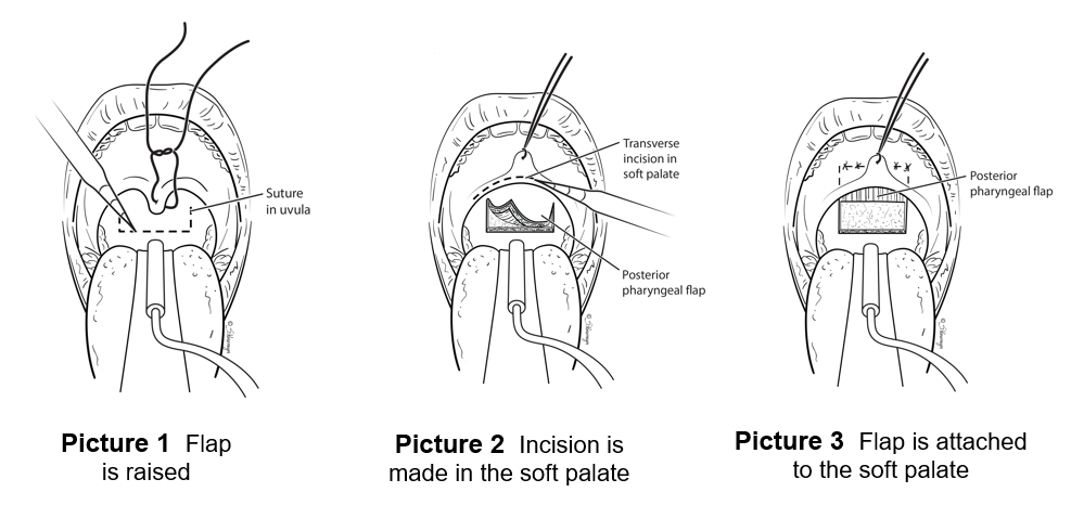Three images demonstrating that the flap is raised, the incision is made in the soft palate, and the flap is attached to the soft palate.