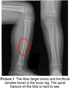 Toddlers Fracture