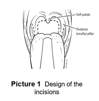 Design of the incisions