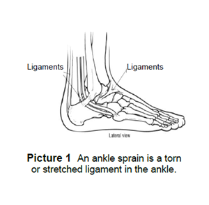 An ankle sprain is a torn or stretched ligament in the ankle