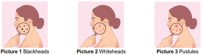 Blackheads, whiteheads, and pustules on a face under the view of a microscope.
