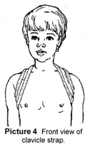 Front view of clavicle strap