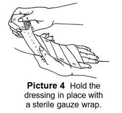 burn dressing