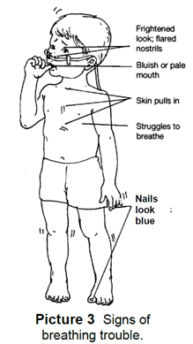 Signs of breathing trouble in a child
