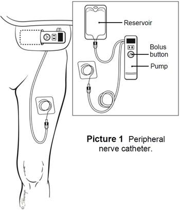Peripheral nerve catheter.