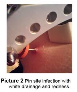 Pin Site Infection