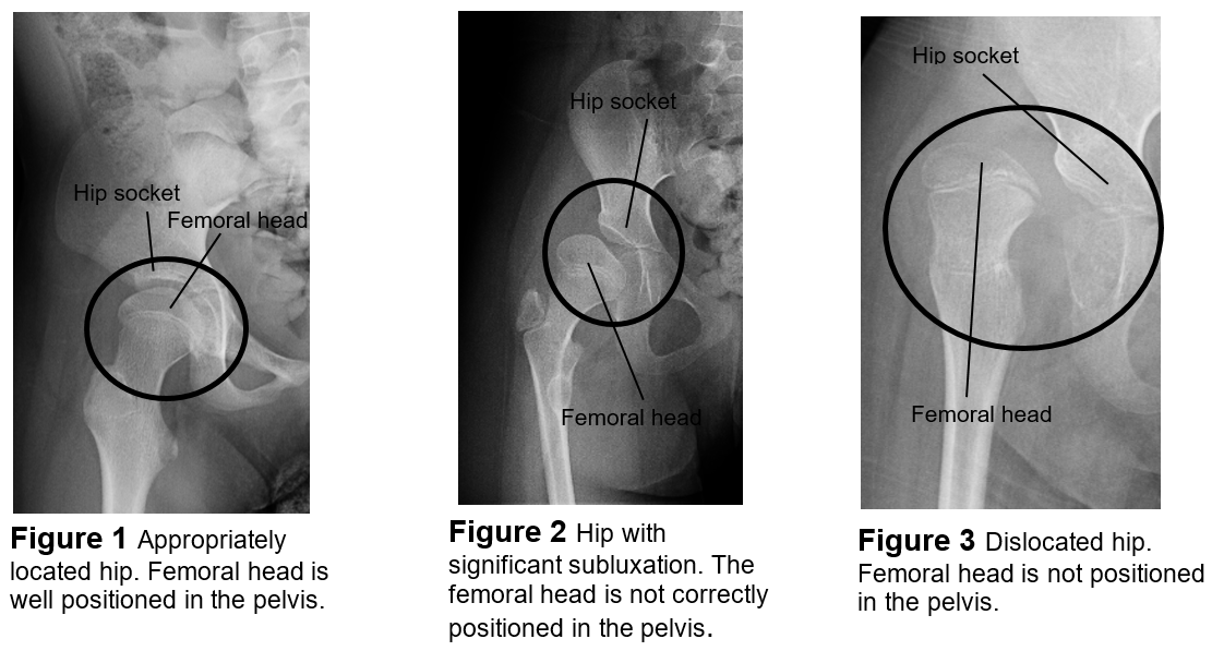 Three figures showing the appropriately located hip, a hip with significant subluxation, and a dislocated hip