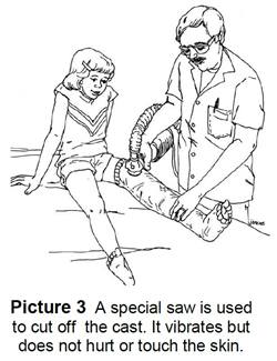 Cast being taken off using saw