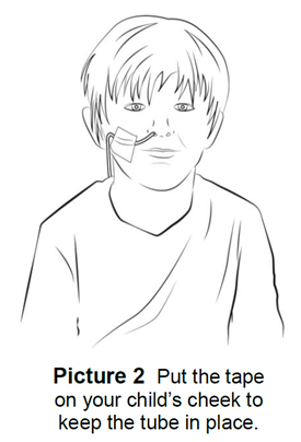 Child wearing NG tube.