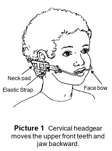 Your child should wear the headgear at least 14 hours a day