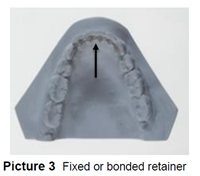 Fixed or bonded retainer