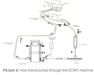 diagram of how bloods pumps through an ECMO machine