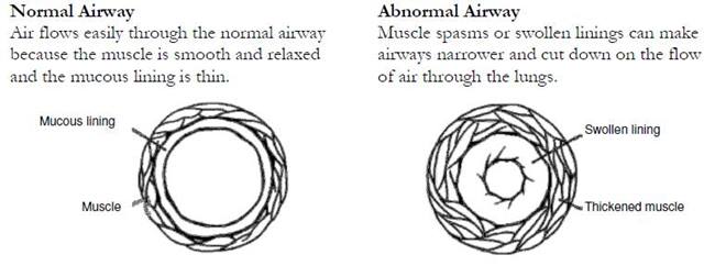 diagram of normal and abnormal airways