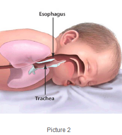Baby is more likely to choke when sleeping on stomach